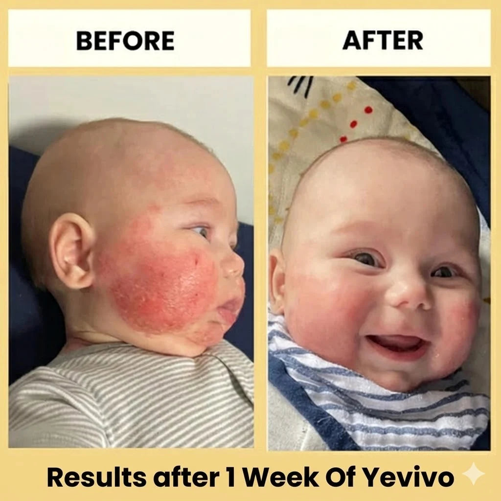 Yevivo Eczema Cream