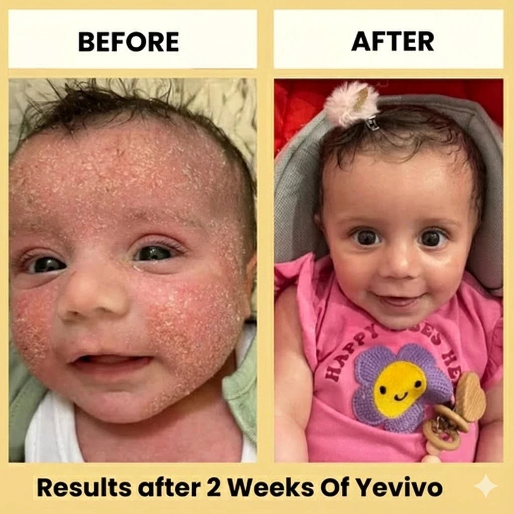 Yevivo Eczema Cream