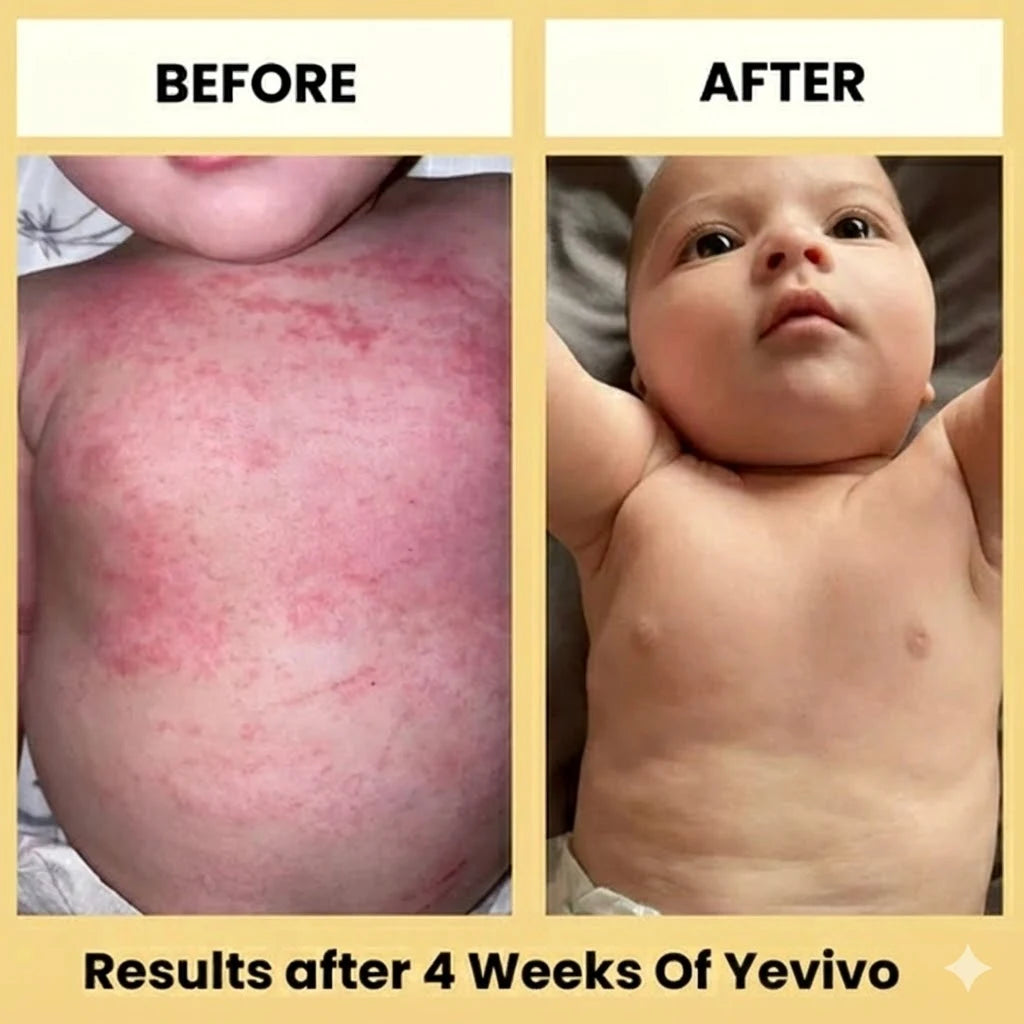 Yevivo Eczema Cream